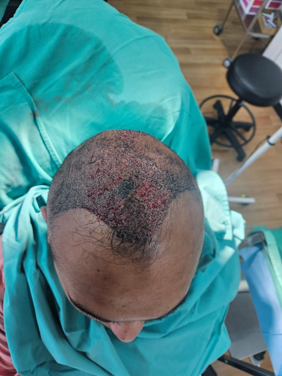 khairul_hafidz's tweet photo. Alhamdulillah selama dua hari ini saya telah menjalani satu prosedur perubatan yang dinamakan hair transplant.

Prosedur ini telah lama saya ingin lakukan tapi baru kali ini mendapat peluang.

Mula-mula berdebar juga macam mana prosedur ini dilakukan. Prosedur ini dilakukan selama dua hari. Hari pertama hair transplant dibuat di sebelah kanan dan hari kedua pula di sebelah kiri.

Macam mana hair transplant ini dibuat? Terdapat dua proses iaitu extraction and planting. Rambut daripada bahagian belakang dan tepi akan di ekstrak dan setelah itu akan ditanam di bahagian depan dan tengah.

Hari pertama boleh tahan juga rasa sakit walaupun telah diberikan bius lokal. Yang sakit sewaktu pemberian ubat bius dan sepanjang proses ekstrak itu juga kadang kala ada rasa sakit sewaktu proses tersebut. Hari kedua kerana dah mentally ready, jadi tak rasa sakit sangat dah.

Yang paling penting dalam hair transplant ini adalah seni daripada pakar sendiri, bagaimana beliau merancang bagaimana rambut itu hendak ditanam. Kalau salah tanam maka memang tak cantiklah hasilnya.

Syukur sebab apa yang dirancang itu berjaya. Cantik rambut yang ditanam. Saya berpuas hati dengan hasilnya.

Tanam rambut ini, kita cuma ada satu peluang. Kerana rambut yang telah diekstrak tak dapat tumbuh kembali, dan kalau rambut itu mati maka tak dapatlah hasil yang kita mahukan. Sebab itu penting siapa pakar yang akan membuat prosedur ini.

Oleh itu, saya sangat sarankan untuk yang berminat membuat hair transplant, buatlah dengan Dr Wan Syazli, Pakar Bedah Plastik dan Rekonstruksi di Avicena Hospital Shah Alam. InsyaAllah service terbaik dan hasilnya sangat memuaskan.