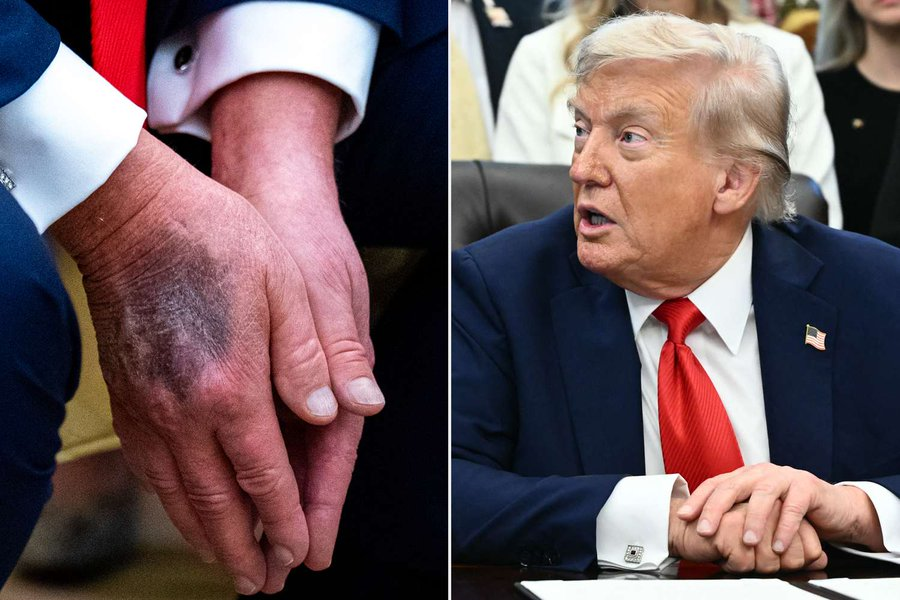 politvidchannel's tweet photo. BREAKING: Trump could be forced to resign or be removed in a matter of weeks.

Doctor says Trump is VERY SICK 

DOCTOR: TRUMP has “severe daytime somnolence… Chronic insomnia is a severe illness. It can result in an increase in risk of dementia, decrease in cognitive effects in older people.”