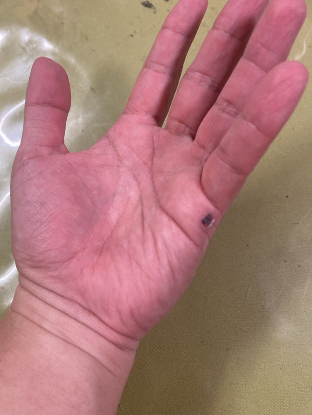 9tarou_weakweak's tweet photo. 多分トロンボーン吹きにはわかってもらえるこの血豆😵
左手の平、小指下辺り…。

ハイ、戻ってくるスライドに挟みました😵多分、およそ25年ぶり3回目くらいかな。
ちょいと中途半端な持ち方してたのが悪い💦
あまりのキレイな血豆の出来具合に我ながら感心しております😝
#トロンボーン
#左手の血豆 https://t.co/I8Io8EF6XO