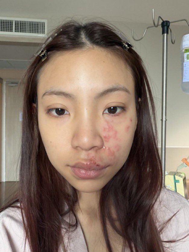4EVEinterbase's tweet photo. Taaom shared that she battled shingles shortly before #4EVEUnchainedConcert and had to focus on her recovery during the show’s preparations. ❤️‍🩹

We’re happy to see her healthy and shining on stage! 💜

#4EVE #ตาออม4EVE #Taaom4EVE  https://t.co/KHTbdS4k36 https://t.co/AMWjOaYsQl