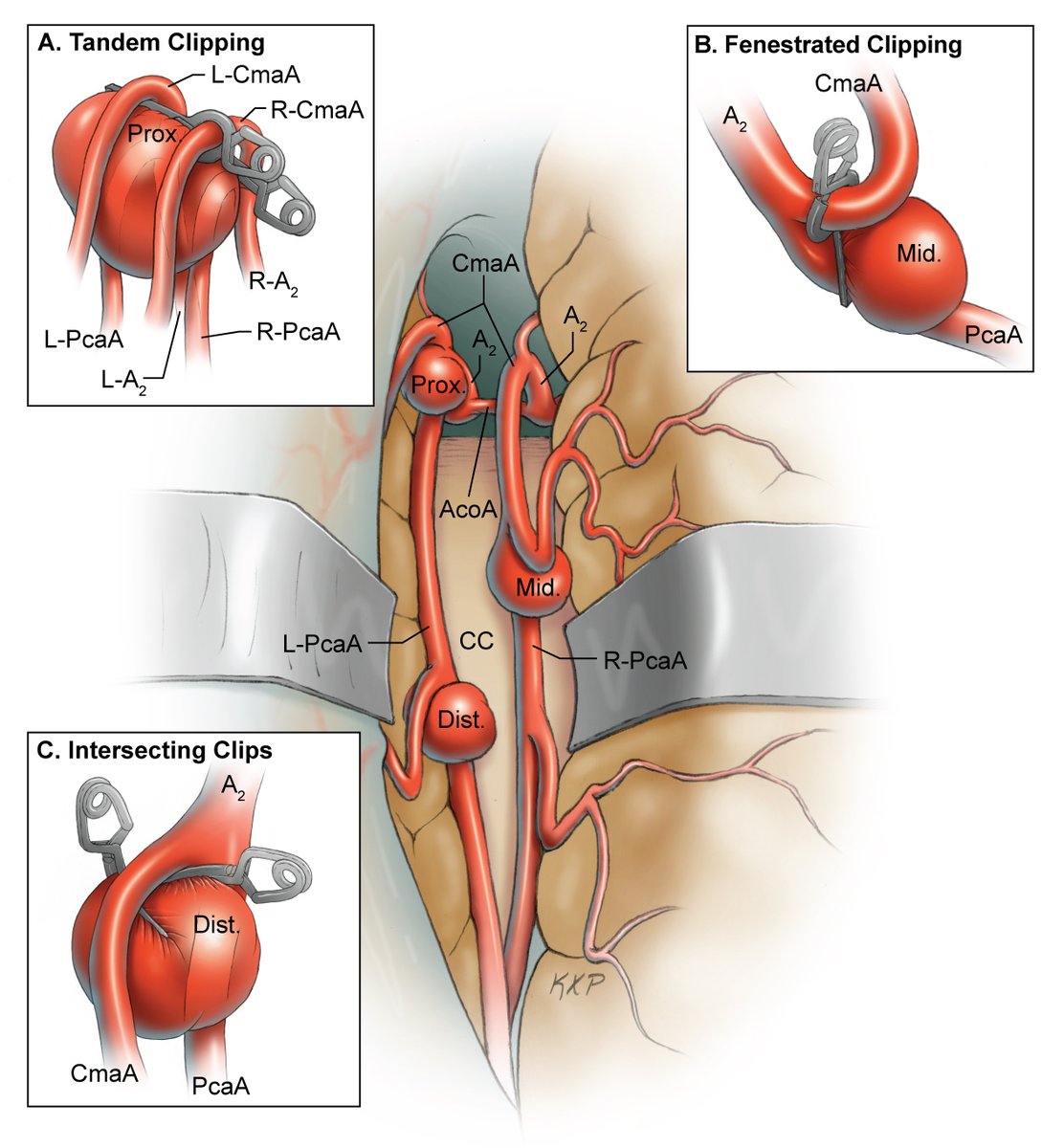 mtlawton's tweet photo. Watch this #SevenSeries video showing this mini bifrontal craniotomy, anterior interhemispheric approach, and clipping of distal pericallosal artery aneurysm, on our website @BarrowNeuro by clicking on this link… https://t.co/J7JSfScET4. https://t.co/JMrQP3nbWe