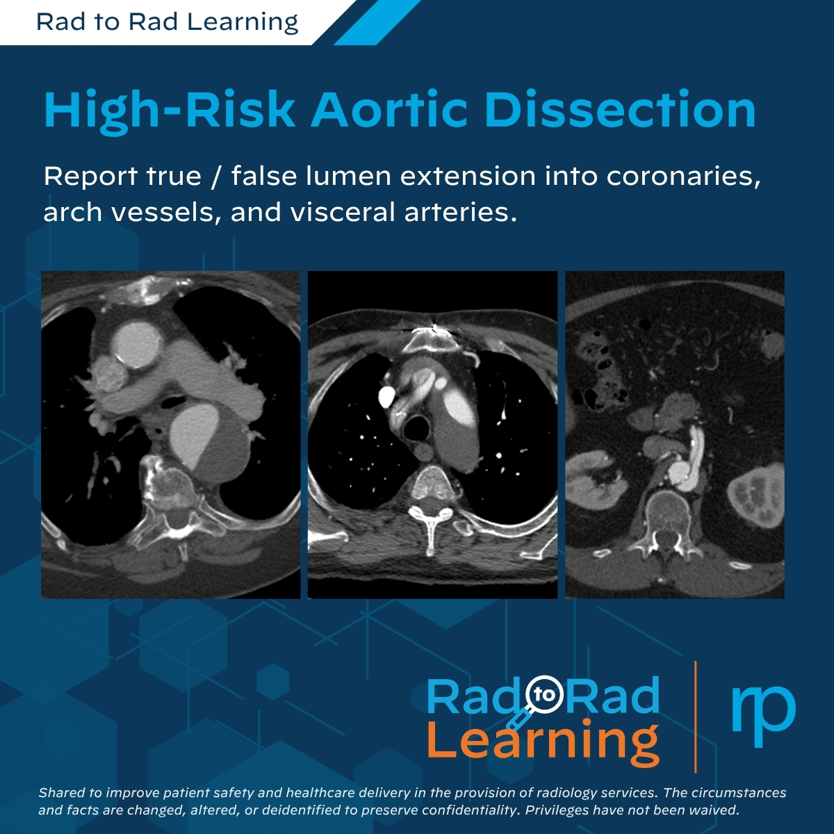 Rad_Partners's tweet photo. 📣 New Rad to Rad Learning case
This #PeerLearning case reviews key imaging findings in high-risk aortic dissection & their role in guiding management.
🔔 Accurate characterization of dissections improves patient outcomes.
Explore & share the case: https://t.co/wKZG337ec7 https://t.co/p4tJdOlidd
