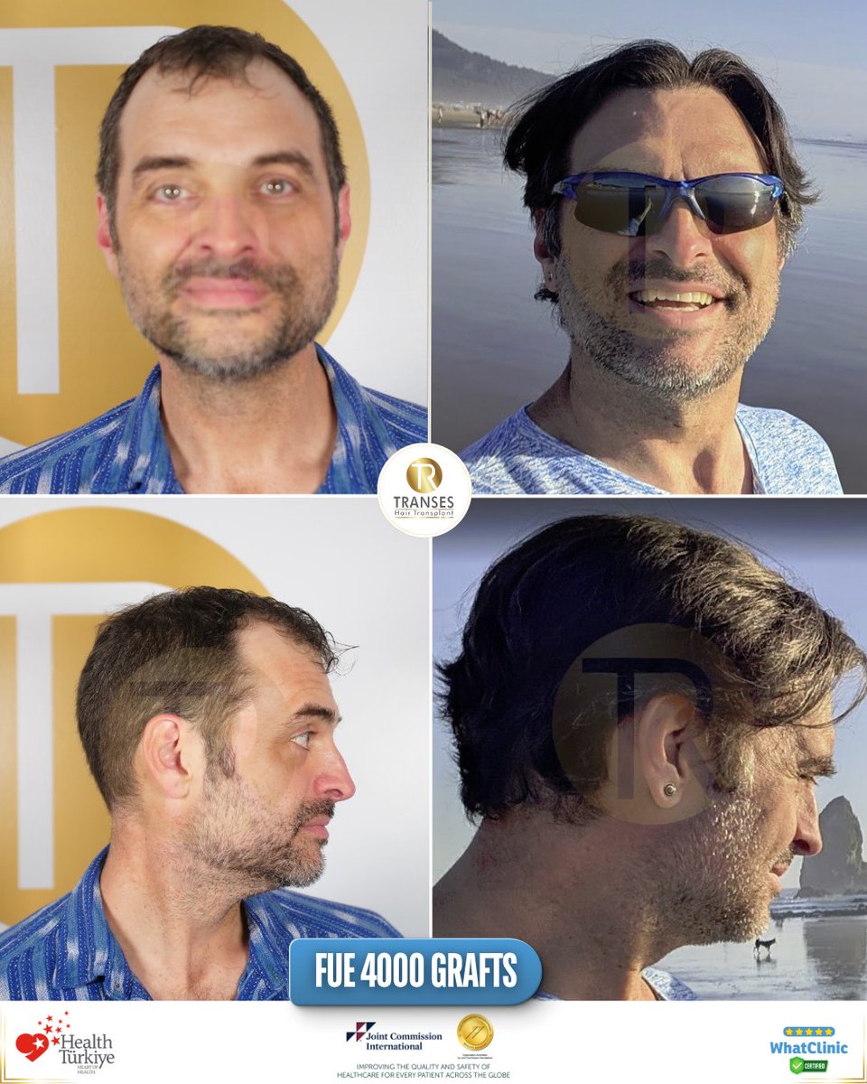 transeshair's tweet photo. This hair transplant operation was performed at Istanbul Tema Hospital BHT Clinic.
15 years of experience with a 4.9 ⭐ WhatClinic rating.
FUE • DHI • HYBRID • PRP
Natural results, professional care.

#YourJourneyYourTransformation
#TransesHairTransplant
#FUE #DHI #PRP https://t.co/M7J0EIa4bs