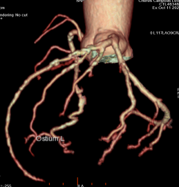 smexcardiologia's tweet photo. #CardioClave 🫀
La anatomía identifica la lesión, pero el FFRct revela su impacto funcional. Más allá del grado de estenosis, permite reconocer qué lesiones coronarias generan isquemia y orientar una mejor toma de decisiones clínicas.
🔎 Del diagnóstico anatómico al diagnóstico funcional.
#FFRct #TomografíaCardiaca #ImagenCardiovascular #CardioClave #SociedadMexicana #soysmc