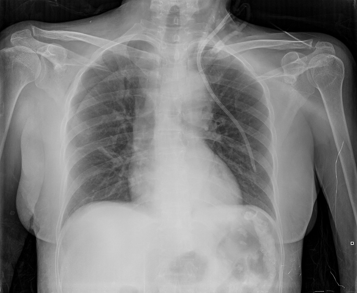 AcidoRinon's tweet photo. ¿Revisaste el catéter del R1?

“No, pero me dijo que lo puso con el Dr de la noche que es un buenazo, ni ultrasonido le gusta usar”

💀 https://t.co/6tIUiFjICP