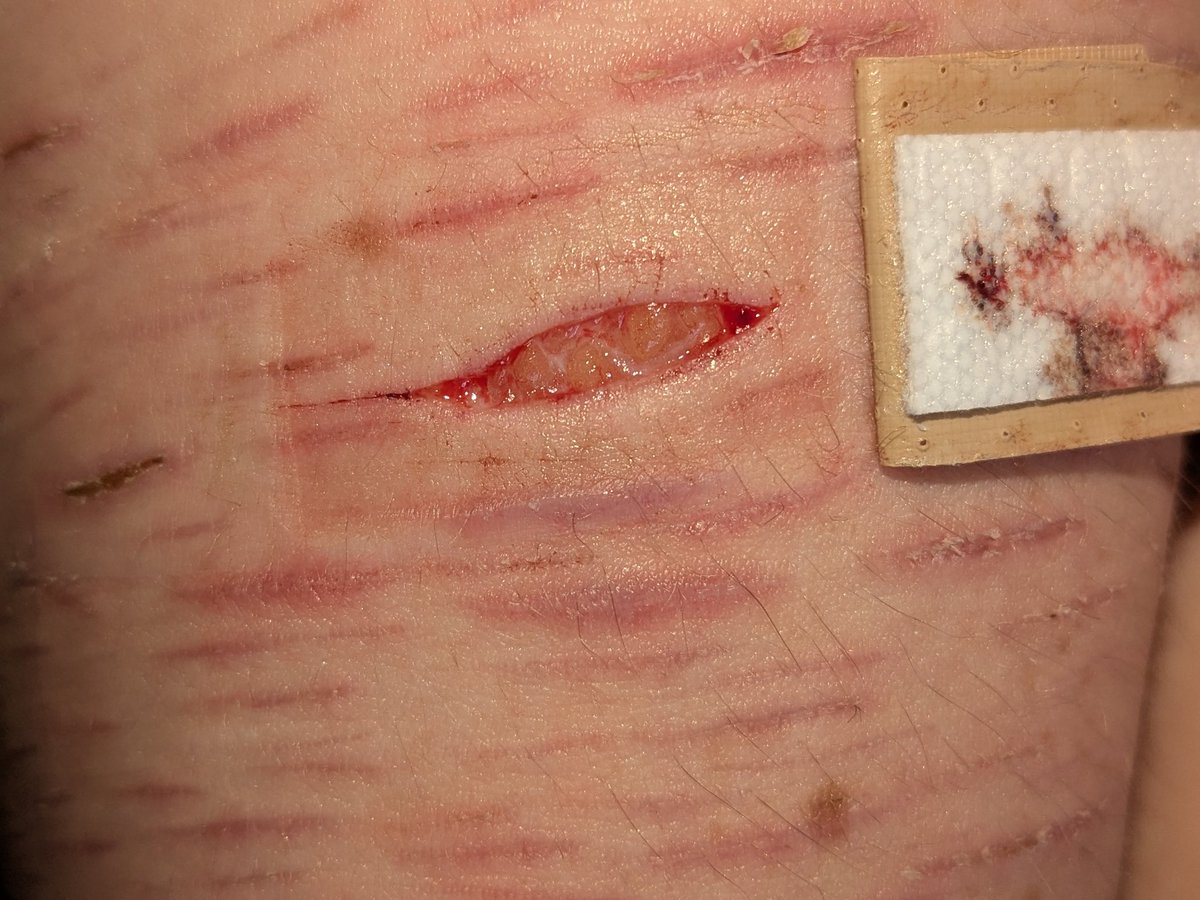 Jobbleshobble's tweet photo. Beans day two hopefully this scars really good. Apparently we're going somewhere Friday? I'll update https://t.co/Mr6tHXl6LF