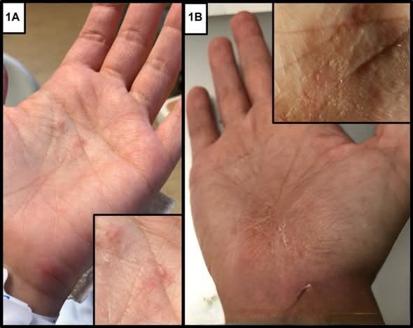 albertoortegana's tweet photo. What's the diagnosis? Patient with a history of severe acne vulgaris treated remotely with isotretinoin presented with acute pain of the neck and lower back and associated radicular symptoms. Physical examination found tenderness over the sternoclavicular joints bilaterally along with occasional scattered pustules on the left palm (Fig 1, A) and nontender grouped, deep-seated vesicles with crust on the right palm (Fig 1, B). Magnetic resonance imaging of the spine found multiple foci of abnormal bone marrow signaling in multiple vertebral levels and the left iliac bone (Fig 2). Core biopsy of the left iliac bone found normal bone negative for cytokeratin AE1/AE3, and cytology was negative for malignant cells (Fig 3). 
Diagnosis?