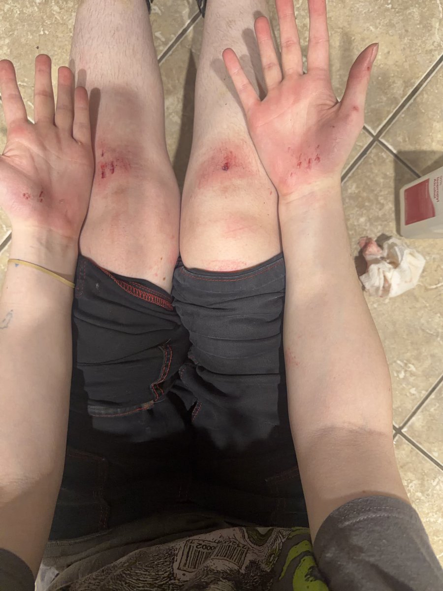 creeperstonerr's tweet photo. Do some people like when I’m scraped up or do I need to find a way to hide this until it heals😔 https://t.co/6s9YisuL6T