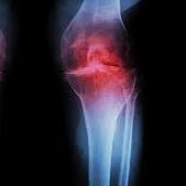 NightSkyToday's tweet photo. JUST IN🚨: Scientists created a single injection that can literally regrow damaged joints in weeks. https://t.co/QjFScfhGuR