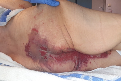 schowardjd's tweet photo. A woman in her 70s w/ no prior derm hx presented w/ several months of asthenia, weight loss, depression, & a progressive eruption. 

Lesions began on the LLE & spread to the gluteal/perineal regions, groin, lower back, & perioral skin. 

O/E: annular/polycyclic erythematous plaques w/ advancing erythematous borders, central clearing/healing, scale, crusting, erosions, & residual PIH. Lesions were nonpruritic & nonpainful. She also had glossitis and B/L proximal femoral DVTs.

What’s your DDx❓