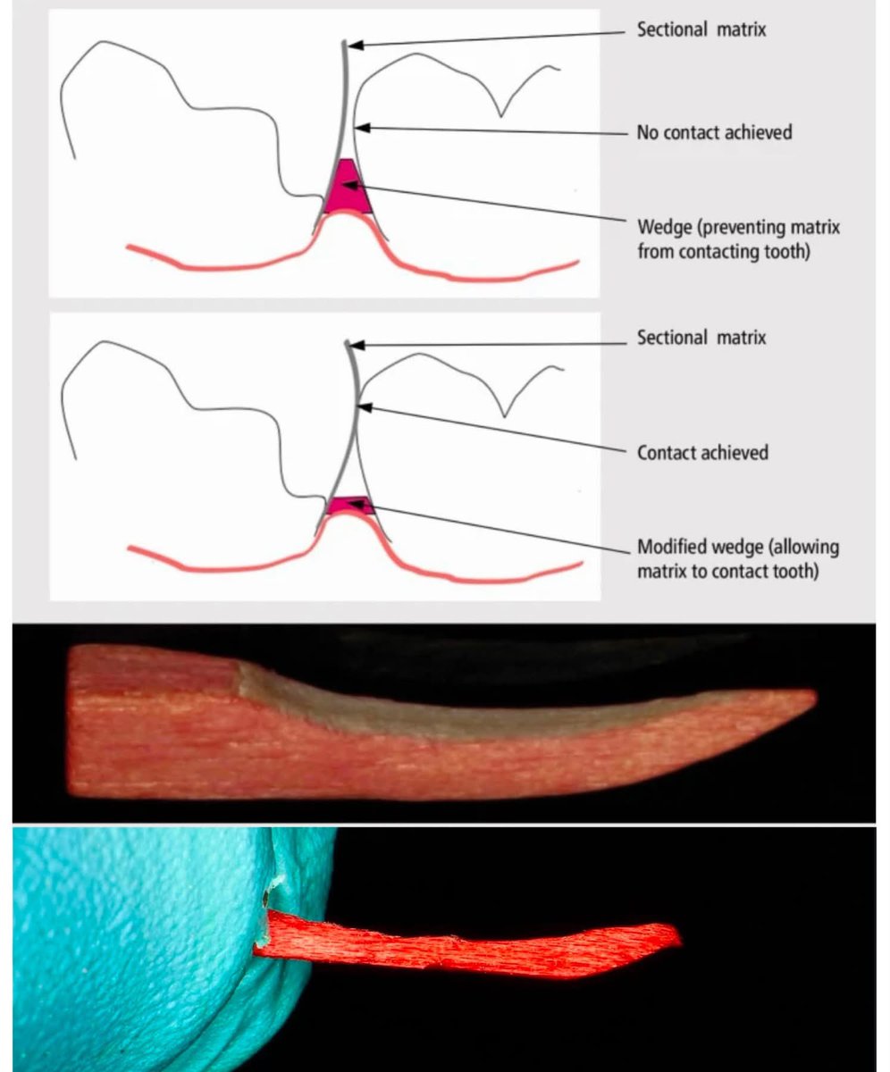 aboutDent's tweet photo. Wedge modification to exceed band deformation ✅

#dental #dentist #dentistry https://t.co/DF9UQ360Sl