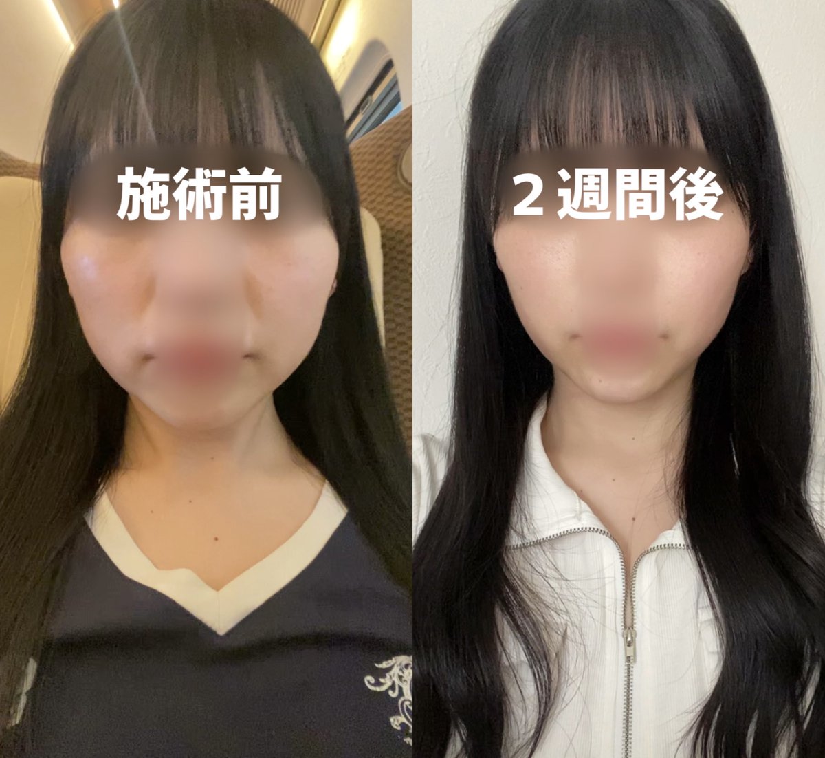 16244_'s tweet photo. 【🇰🇷渡韓せずに韓国美容が受けられる】
📍ベンスクリニック 新宿店

施術内容(自費も含む)
・エラボトックス 60U
・脇ボトックス 100U
・インモードfx(ほうれい線)

ボトックス系は3週間で効果実感✨インモードは頬こけせずに、ほうれい線だけに効いて薄くなったし、その周りのお肉も消えた😭👏🏻

 #PR https://t.co/WZYAisGfCD