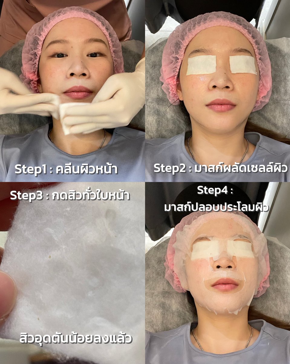 anne_nosorus's tweet photo. รีวิวกดสิวที่พรเกษมโปรแกรมที่แอนทำคือ Acne Exit อันนี้คือเข้าไปกดได้เลยในราคา990บาทได้ทำ4ขั้นตอน

-ขั้นแรกพี่เขาจะมาคลีนผิวเราก่อน พี่เขาเช็ดแบบเบามือมาก (ไม่ต้องแต่งหน้าไป ก็ได้นะ ส่วนเราไปทำธุระมาก่อนเลยขอแต่งหน่อย)
-ขั้นสองจะมาสก์ผลัดเซลล์ผิวข้อดีเลยคือจะกดสิวง่ายขึ้นนอนรอไปประมาณ5นาที
-ขั้นสาม ขั้นนี้ที่คนกดสิวรอคอยเริ่มกดสิวทั่วใบหน้า พี่เขาคอยถามตลอดเลยว่าไหวมั้ยประมาณนี้ได้มั้ย ชวนคุยด้วยคือดีมากๆ
-ขั้นสุดท้าย มาสก์ปลอบประโลมผิวอีกทีขั้นตอนนี้ฟินมากนอนได้เลย

เราแนะนำเลยใครเป็นสิวอุดตันอย่าพยายามกดเองเพราะถ้าเรากดไม่หมดสิวอักเสบตามมาแน่นอน