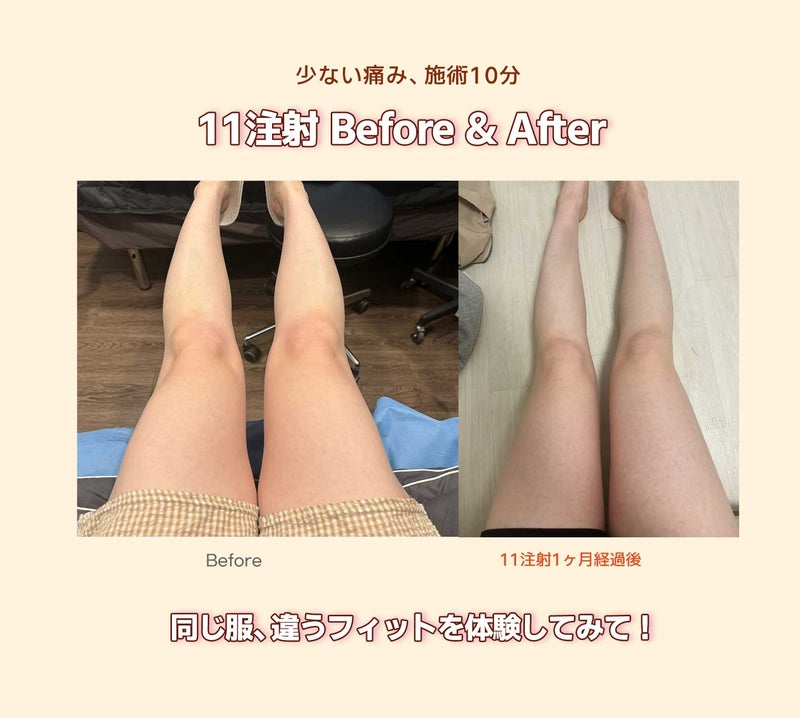thewayps's tweet photo. ふくらはぎのお悩みには💉✨

筋肉には ボトックス、
脂肪には 脂肪溶解注射💙

気になる脚ラインをまとめてケア💖

 ザウェイでは、特別イベント価格でご案内中✨

▶LINEで相談OK👉https://t.co/X6fagL3DkK

#韓国脂肪溶解注射 ＃ふくらはぎ脂肪溶解注射 ＃ふくらはぎボトックス https://t.co/pYRcm0U0Je