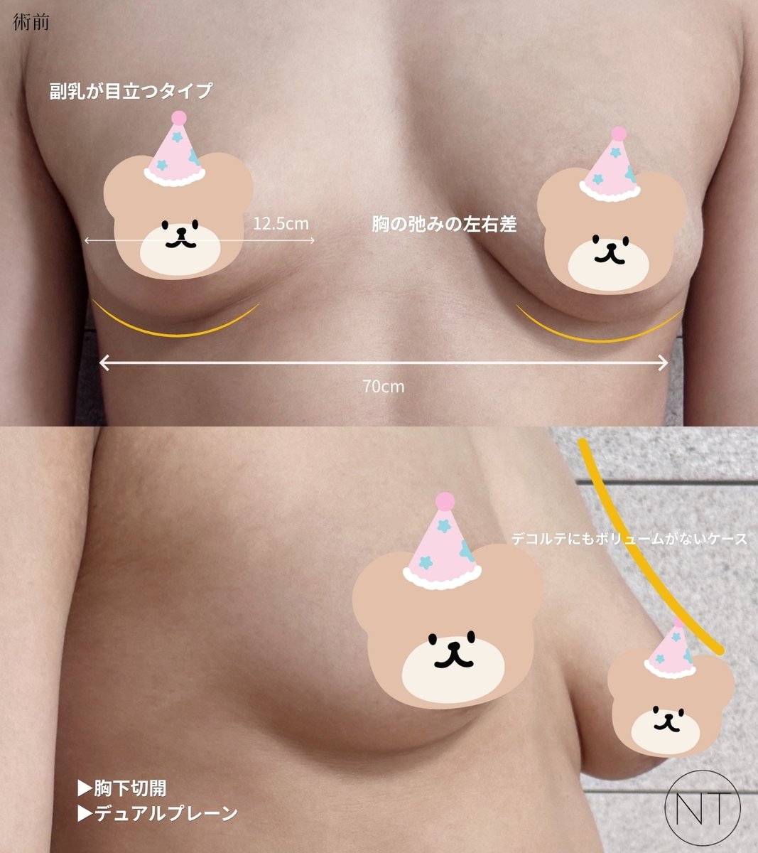 notejp_arte's tweet photo. < モティバ フル Motiva Full 355㏄ / 胸下切開 >
・ 身長/ 体重：153cm/48㎏
・ クォン・スングン院長

患者様からのリアルレビューをご紹介します📓

豊胸手術をしてから、服選びも楽しくなり
自信がどんどん高まっています💜

胸を変えただけなのに
思っていた以上に色々なことが変わって、自分でも驚いています。

何より手術後、一番喜んでいるのは主人です(笑)
手術したことを言わなければ
触感では分からないと思うと言っていました🤭

身長が低いので、
手術後に体が大きく見えてしまわないか心配していた時期もありましたが
むしろウエストラインや肩周りなど全体的なシルエットが華奢に見えるようになり
上胸のボリュームがしっかり出たことで胸の形も、とても満足しています🌸

私のように小柄な方の参考になればと思います！

ノート美容外科 豊胸センター Arté 
LINE追加：https://t.co/eyYU3xIT74 

#豊胸 #整形 #韓国整形