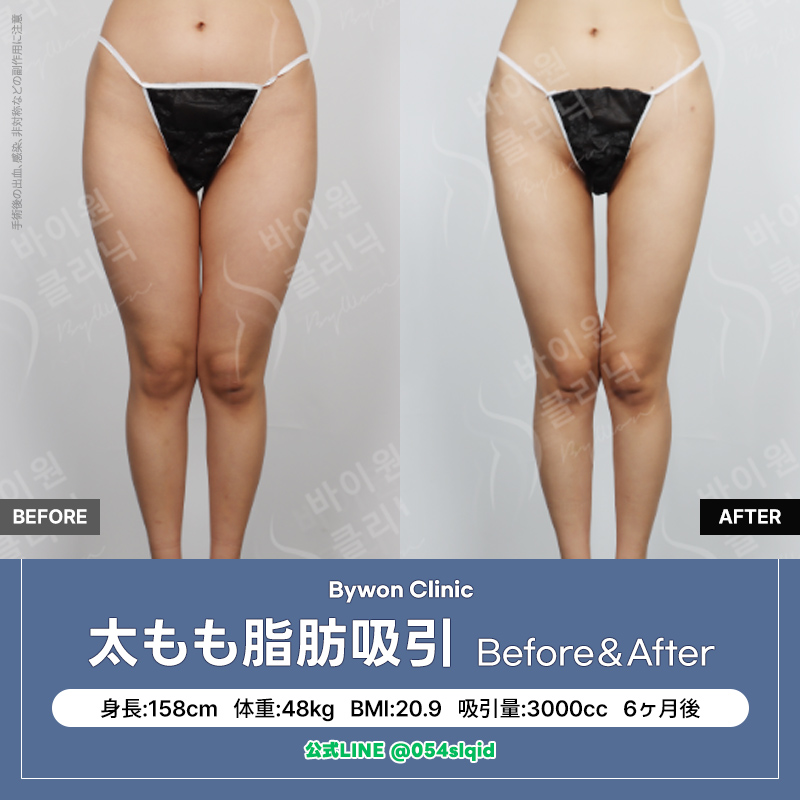 BywonClinic's tweet photo. バイウォン 太もも脂肪吸引

既存のベイザー2・Eva2に加え
米国食品医薬品局(FDA)承認の
レヌビオンを導入で
脂肪吸引後のたるみケア💡

病院名を一切変えず、
ひとつの場所で積み重ねてきた
経験・技術・ノウハウを基に
オーダーメイドの脂肪吸引を🎵

今すぐ公式LINEまで無料オンラインカウセを💌
💌https://t.co/WU2fCoVWJK

#韓国整形