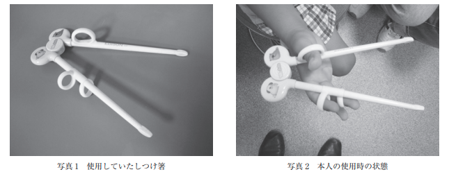 AoringoDr's tweet photo. ⚠️【注意喚起】便利な「しつけ箸」、持ったまま遊ぶと思わぬ大ケガに繋がります！
日本小児科学会からの重要な報告です。

【Injury Alert No. 24 しつけ箸による刺傷】  

🍎 実際の事故事例
・4歳の男の子が、しつけ箸を持ったままデスク用の回転椅子から転落しました。
・指がリングにはまって抜けず、箸先が下顎に刺さり、2針縫合するケガを負ってしまいました。 

 🍎なぜ大ケガになるの？
①手から外れない： リングで指を固定する構造のため、転んでもとっさに箸を手放せません。 

 ②丸い先でも刺さる： 箸先が丸く加工されていても、転落などの強い力がかかると皮膚を貫いてしまいます。  

③顔に近い： 手指で使う補助具は顔の近くにあるため、常に顔面や眼球に刺さる危険性が潜んでいます。 

🍎 防ぐための対策
・食事の後は「すぐに手の届かない場所へ片付ける」ことが何より大切です。
・持ったまま歩き回ったり遊んだりしないよう、大人がしっかり環境を整えてあげてくださいね。

子どもたちを痛いケガから守るため、ぜひリポストでパパ・ママ友への注意喚起にご協力ください！