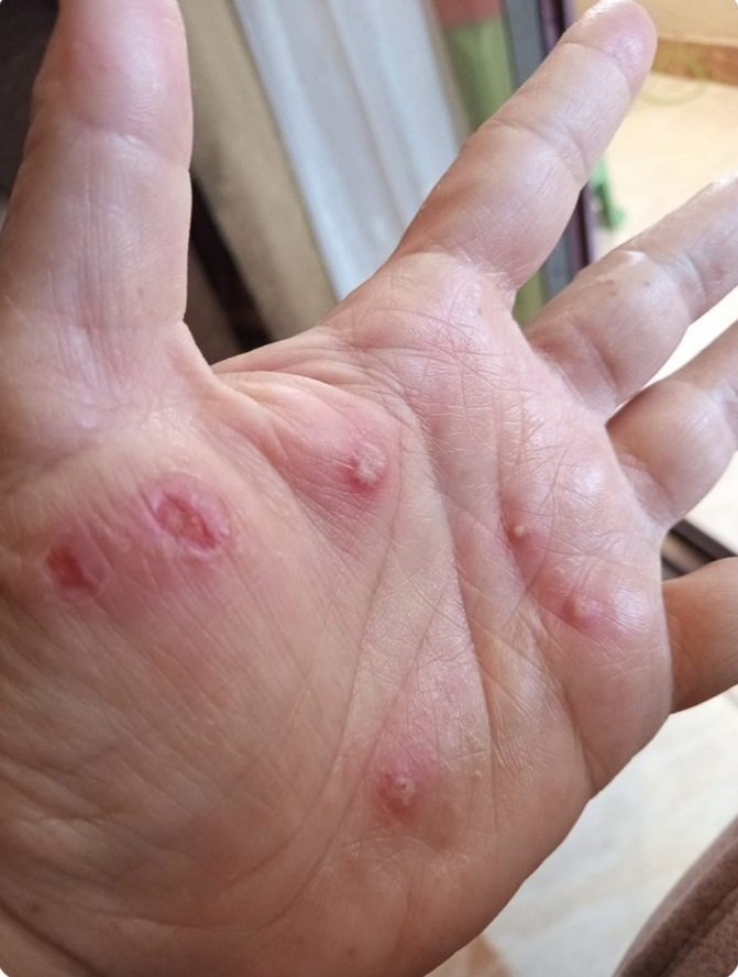 shhd13295's tweet photo. Due to lack of support and money, I cannot buy medicine for my aching hand. Please help me to ease my pain. 🙏🙏💔
https://t.co/Bkjjb7pPly https://t.co/KEIAxV8wJu