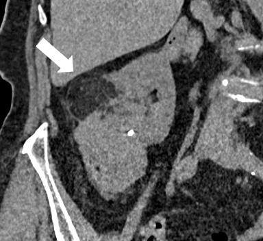 ETF_IRtrainees's tweet photo. 💡Selective transarterial embolization is a safe, nephron-sparing, and minimally invasive treatment for renal angiomyolipomas (AMLs). 

1/3 https://t.co/zo6Ha8p770
