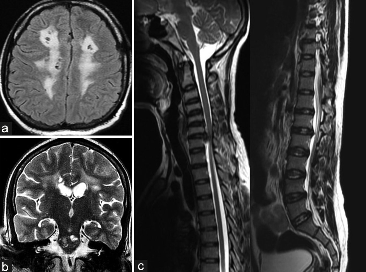 AnnIndAcadNeur's tweet photo. CARASIL is a monogenic stroke syndrome caused by HTRA1 gene mutations. Classical triad- stroke in young,  backache and alopecia. Matthew et al presented one classical case with review of literature of all CARASIL cases published from India @neuro_ian Link: 10.4103/aian.AIAN_31_20 https://t.co/5HZ0k3CuxP