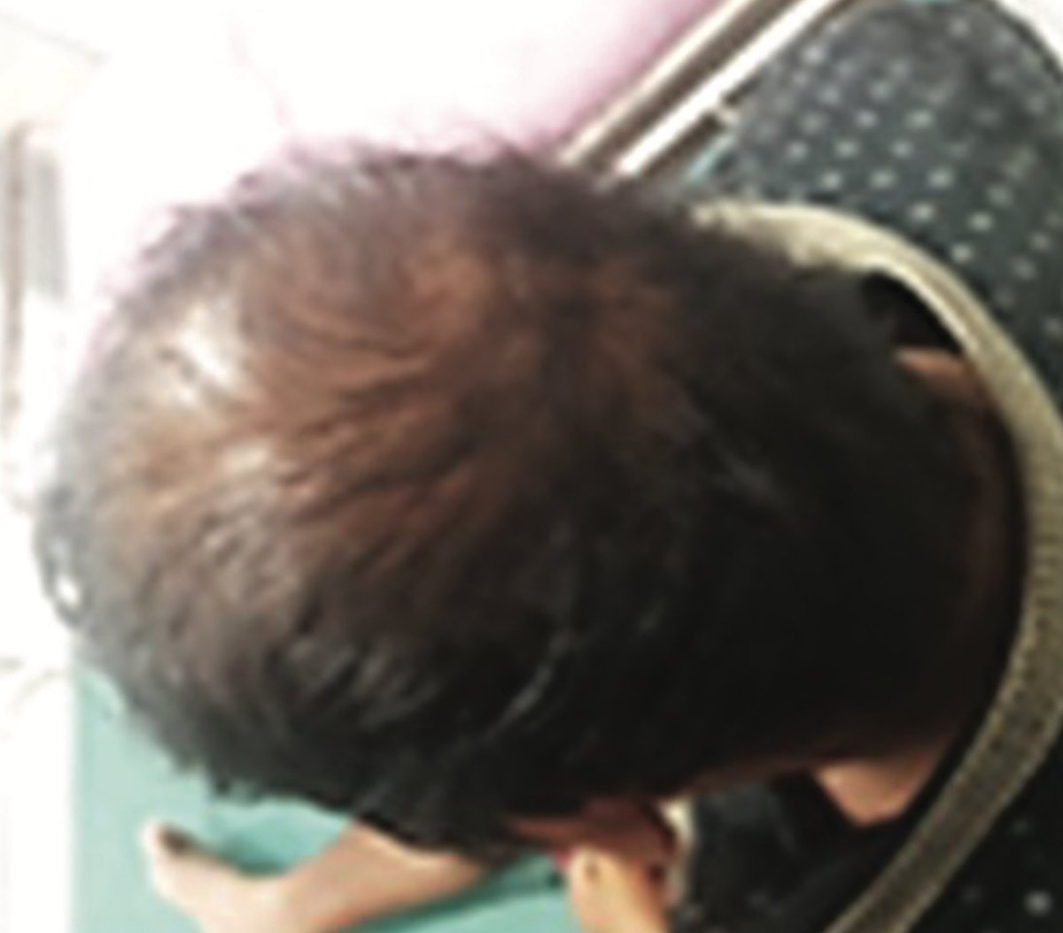 AnnIndAcadNeur's tweet photo. CARASIL is a monogenic stroke syndrome caused by HTRA1 gene mutations. Classical triad- stroke in young,  backache and alopecia. Matthew et al presented one classical case with review of literature of all CARASIL cases published from India @neuro_ian Link: 10.4103/aian.AIAN_31_20 https://t.co/5HZ0k3CuxP