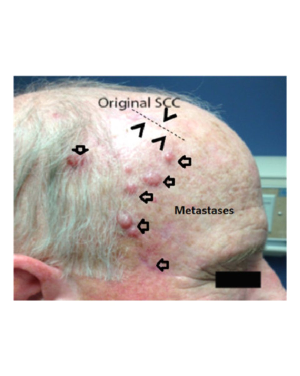theJIDJournal's tweet photo. A commentary by Jeffrey Travers, "Triggering tomorrow’s UVB tolerance therapeutics" https://t.co/TfuFW8BJv2 linked article: https://t.co/0j8fjGj6RY
#JIDJournal #DermatologyJournal #dermatology #dermresearch #dermscience #dermatologyresearch https://t.co/nflVB6SrLJ