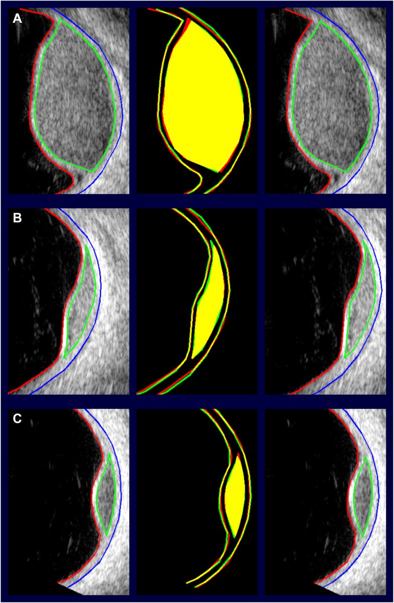 AAOjournal's tweet photo. A Framework for Standardized Manual Segmentation and Measurement of Uveal Melanoma on Ultrasound
https://t.co/uPoZYuQ5PG
#ophthalmology https://t.co/CIjXH7tQz4