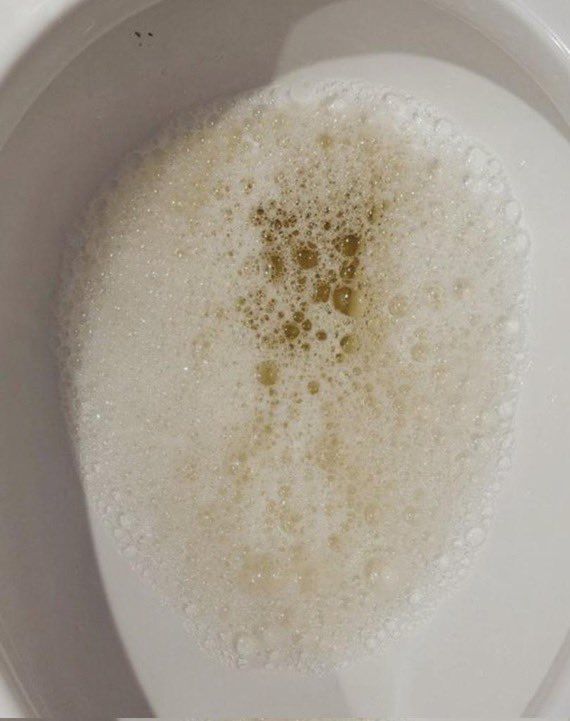 ModReflexion's tweet photo. Señales de que tienes resistencia a la insulina  
(sin darte cuenta de ello)  

1. Aparición de espuma al orinar. https://t.co/s7ZhDozsMd