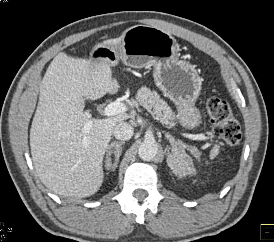 ctisus's tweet photo. Lipid Poor Myelolipoma of the Left Adrenal: https://t.co/pqOuJlWx7q https://t.co/kP4YtYl1Zs