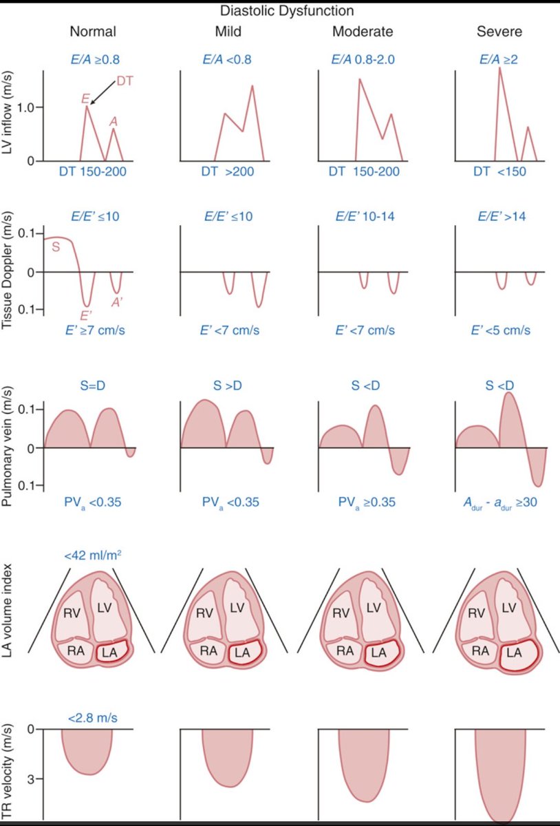 TrackYourHeart's tweet photo. Understanding Diastolic Dysfunction with Doppler Echocardiography
This chart beautifully compares Doppler findings in normal vs. varying grades of LV diastolic dysfunction from inflow (E/A, DT) to tissue Doppler (E′/A′), pulmonary vein flow, LA volume, and TR velocity.

Source: Catherine M. Otto, Textbook of Clinical Echocardiography