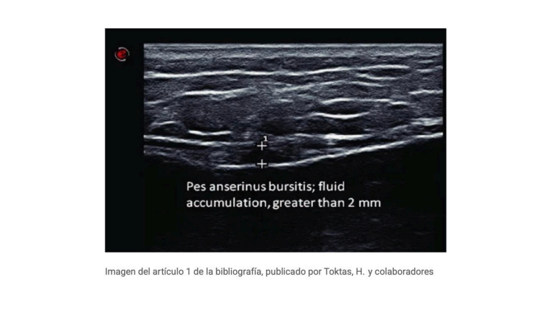 FormacionCalzad's tweet photo. Paula, MIR4, nos muestra la mano que la ecografía puede echarnos en la rodilla. 🧎‍♀️🩼🏀🎯 #juevesecográficos https://t.co/dmoIuIsbTu https://t.co/XAElWYtTJq