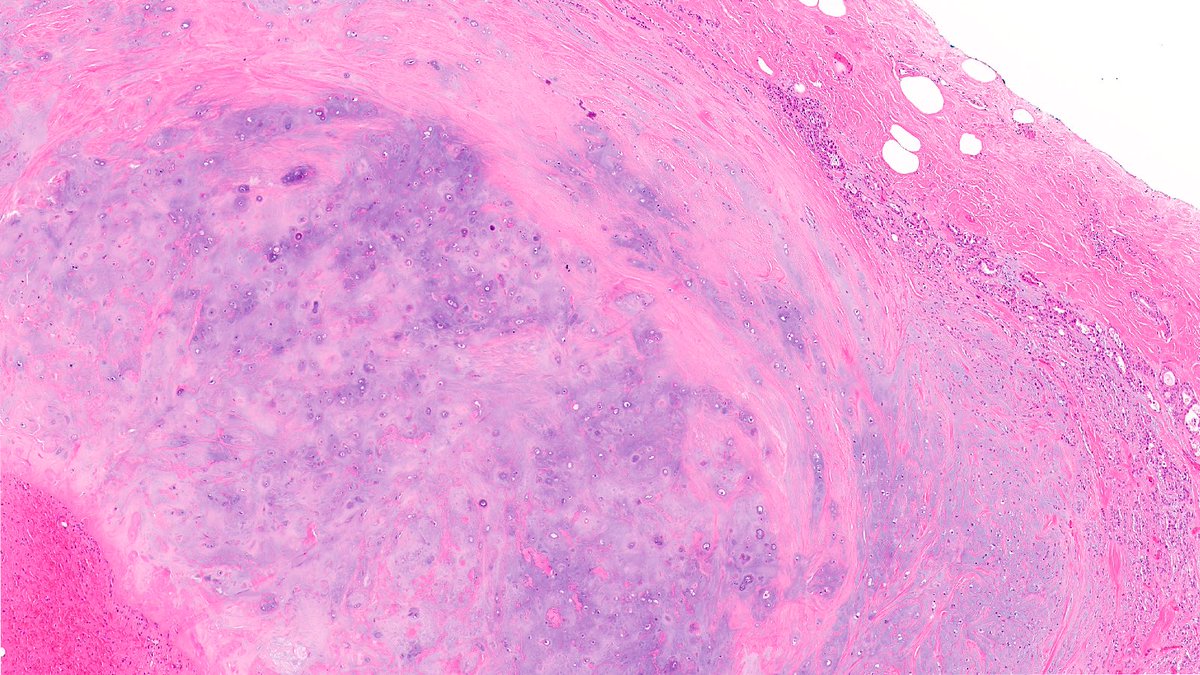 RazaHoda's tweet photo. Pleomorphic Adenoma 🦑🔬

A circumscribed biphasic neoplasm composed of epithelial and myoepithelial cells embedded within a chondromyxoid stroma, closely resembling its salivary gland counterpart.

#PathX #PathTwitter #breastpath https://t.co/AH8EjHsOTM