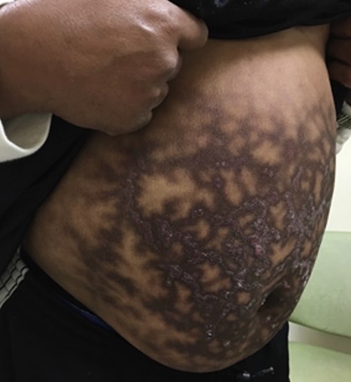 drkeithsiau's tweet photo. A striking rash seen in a patient with longstanding abdominal pain. What’s the diagnosis? https://t.co/rgP9u0lyzr