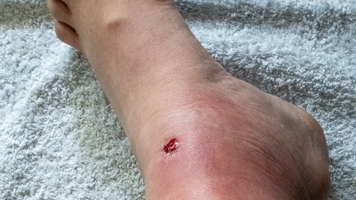 Frontlineer_Hou's tweet photo. About Cellulitis
#FrontlineERRichmond #Cellulitis
https://t.co/3GxHesMppm https://t.co/tAoRWhhbhs