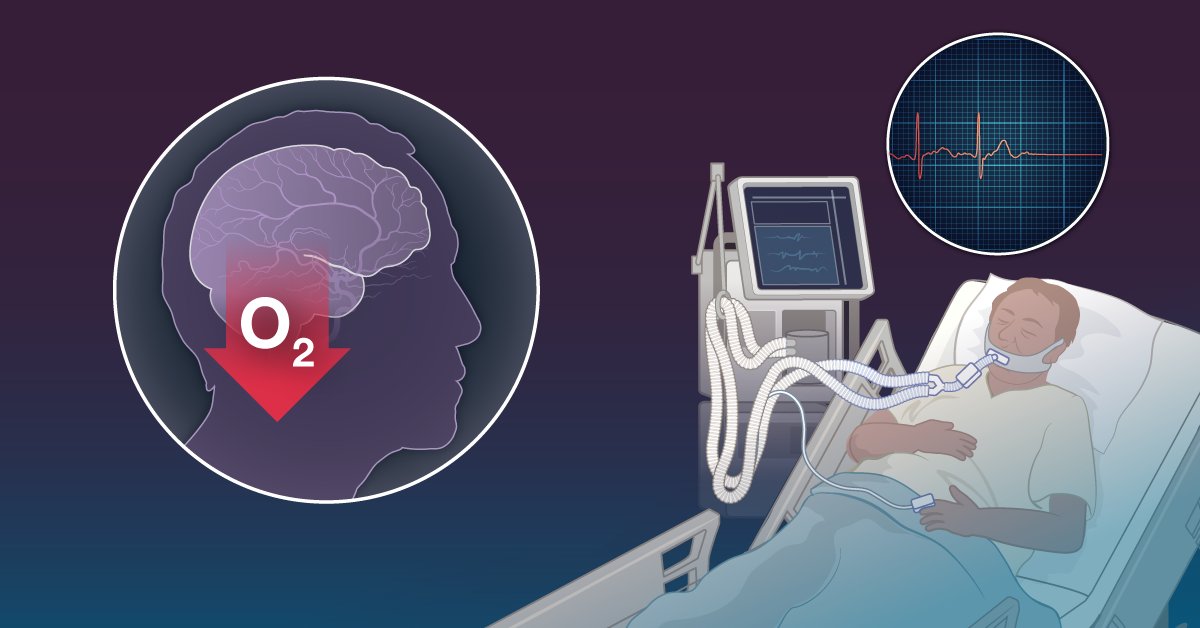 NEJM's tweet photo. In patients with cardiac arrest, reperfusion after circulation is restored can cause brain damage. Whether a conservative oxygen strategy could reduce injury caused by reperfusion is uncertain. Research findings from the LOGICAL trial are summarized in a new Quick Take video. https://t.co/x7ZMXWq5Pr