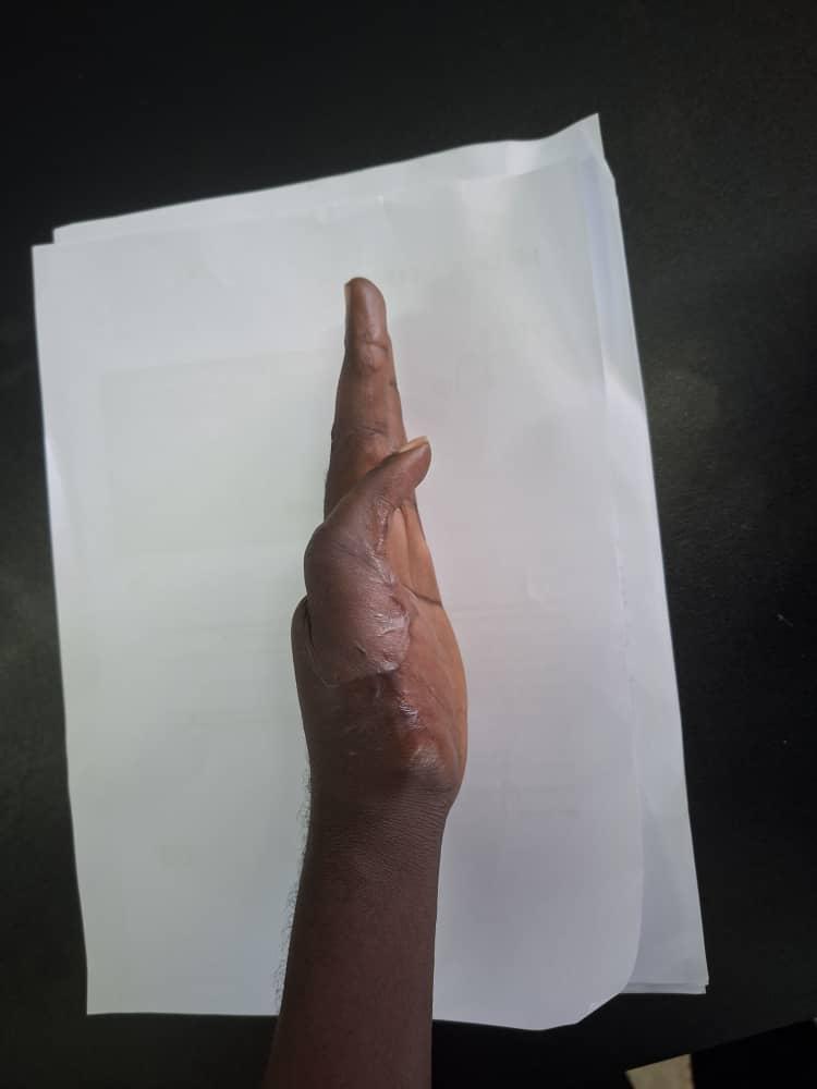 ReSurge's tweet photo. He lost his thumb. A ReSurge team gave it back
 
Read Augustine's story: https://t.co/vGmBTu651F https://t.co/Qt7ydqUJwm