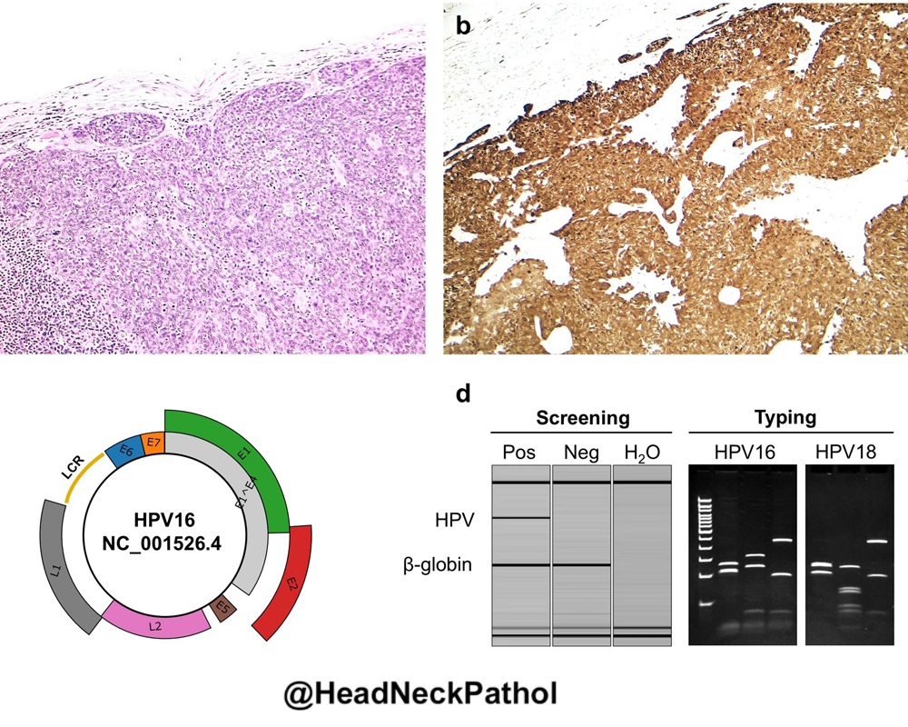 HeadandNeckPath's tweet photo. The Role of Molecular Testing in Head and Neck Squamous Cell Carcinoma of Unknown Primary
Irfan Yasin, Jen-Fan Hang &amp; Ying-Hsia Chu
https://t.co/IIGBC7QojU
#HeadNeckPathol #HNPJ #HeadandNeckPath #Pathology #ENTPath #PathologyTweet https://t.co/6DZ8KkidCi