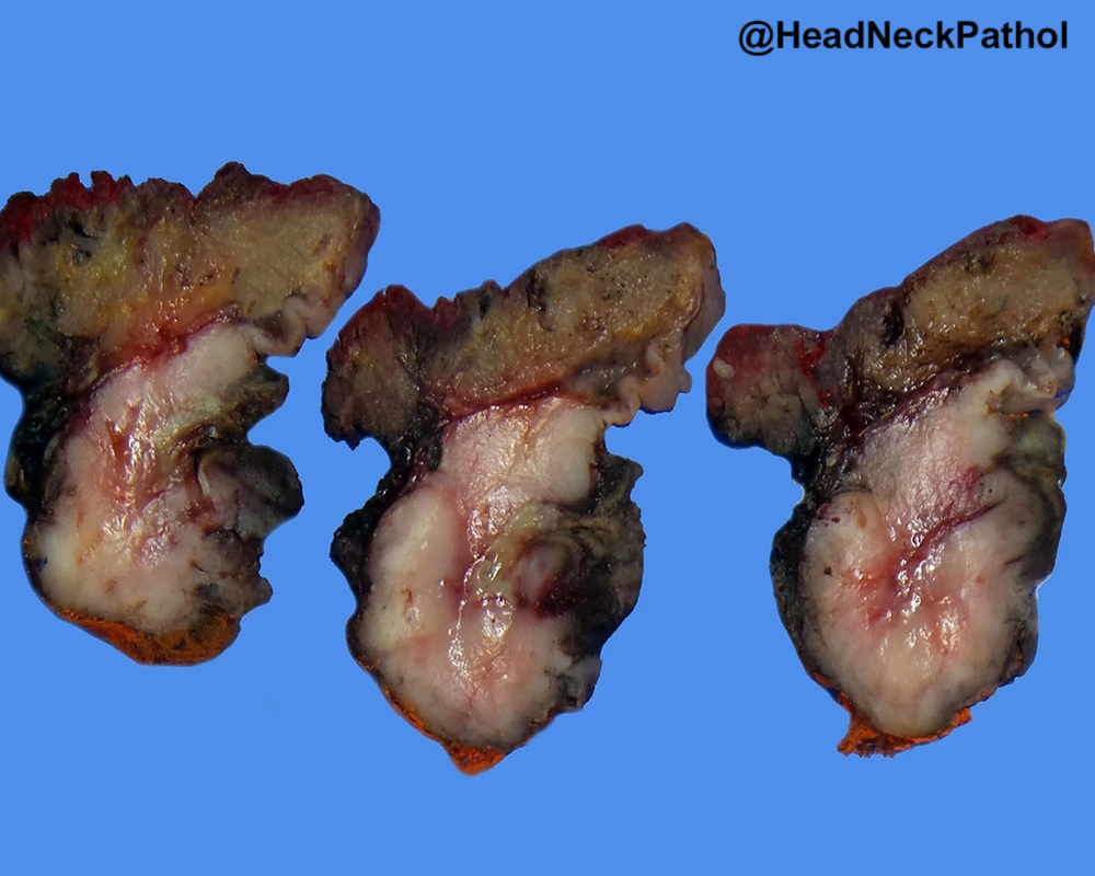 HeadNeckPathol's tweet photo. HPV-Associated Sarcomatoid (Spindle Cell) Carcinoma of Tongue Base with HRAS &amp; TERT Promoter Mutations
Lacey Durham, Lawrence J. Jennings, Yash J. Patil &amp; Borislav A. Alexiev
https://t.co/kGUyUA3oia
#HeadNeckPathol #HNPJ #HeadandNeckPath #Pathology #ENTPath #PathologyTweet https://t.co/1EWKHMbdUV