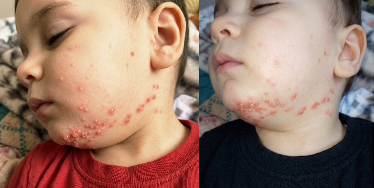 Rozana_0l's tweet photo. My son has a skin rash that's spreading day by day, and the lack of donations is preventing us from securing the treatment he urgently needs. Please donate if you can and share 🙏💔🍉

📎 https://t.co/bPfDAr64k2 https://t.co/asxRNJ9Q6c