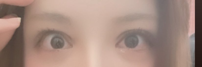 vesfm's tweet photo. 眼瞼下垂＋二重全切開1回目
⇒眼瞼下垂＋二重全切開 修正✨️

失敗されて毎日泣いて死にたくて辛かった私を救ってくれた神執刀医😇✨💕
1年経つけど本当に綺麗でNoトラブル😍 https://t.co/dPM6Ggv833