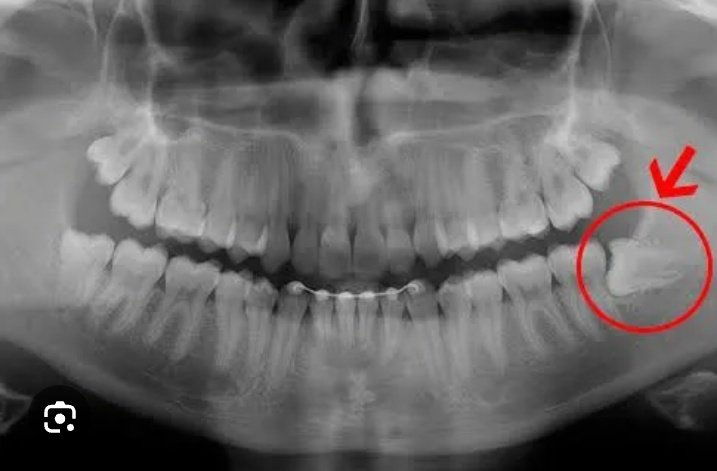 eduardocv3's tweet photo. @PamelaBies I still have all my wisdom teeth, but one of them looks like this: https://t.co/0kBk2PLwBg