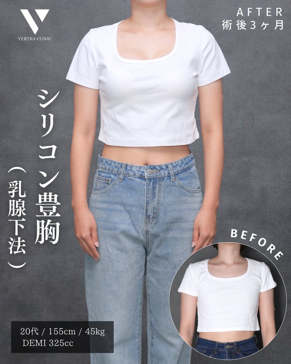 vertraclinic's tweet photo. 《 施術内容 》
シリコン豊胸(乳腺下法)

《 執刀医 》
大阪院院長 河中 聡之(@Dr_kawanaka)

《 詳細 》
女性/20代/155cm/45kg
シリコンバッグ：motiva エルゴノミクス2
シリコンサイズ：DEMI 325cc
挿入部位：脇下 https://t.co/ihqLSUDXJO