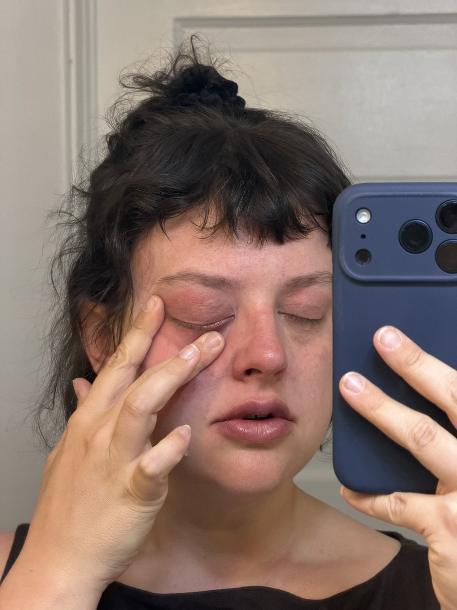 chloe_scout's tweet photo. it might be the high altitude talking but I look lowkey stunning showing off my busted blood vessels https://t.co/LOUo2pvOqw