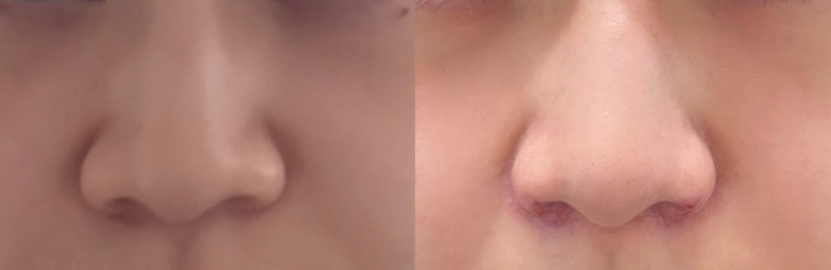 _coco_u_u's tweet photo. 小鼻縮小外側➕鼻孔縁挙上
術後6日　抜糸後

・小鼻縮小の傷はほとんど気にならない
・鼻孔縁はまだ傷有、思ったよりは目立たない
・鼻孔縁の腫れが後1.2割引く、そうしたらもう少し小ぶりになる。らしい
・小鼻の垂れ下がり改善されている
・土手の処理綺麗すぎる❗️天才❗️ https://t.co/xjuGU3d8m0