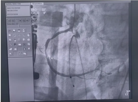 Sunlife_Medical's tweet photo. To treat a patient who experienced recurrent ventricular fibrillation, the emergency director decided to complete PCI under MCC-E chest compression, and subsequently initiated ECMO. Finally, the patient eventually recovered well. #PCI #ECMO #EMERGENCY #ICU #CPR #HOSPITAL https://t.co/CBHQPxGayT