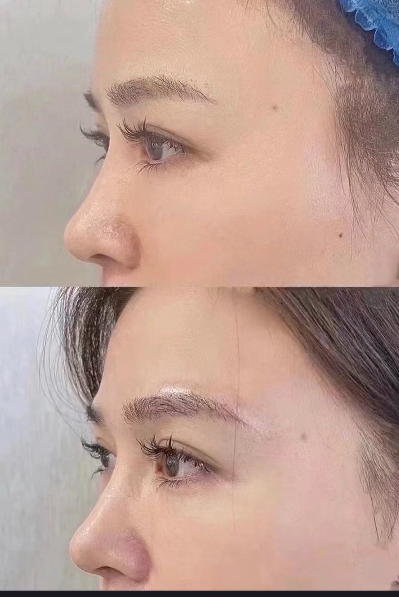 YOU_tarou104's tweet photo. 眉骨形成（プロテーゼ挿入）

💉施術内容
・眉骨形成（250万W）単体

ついに！ついにやってきました〜〜😭😭
念願の眉骨形成‼️‼️（削る方じゃなくて入れる方！）

日本でも韓国でもできる病院少なくて、詰んだと思ってたけど見つけました（ありがてぇ）

💭悩み
・顔全体的に立体感がないが、特に眉骨がなくペタッとしているため堀の深さが皆無で平面顔を助長させている
・西洋人のような堀の深い顔になりたい
・韓国、日本カウセ回った結果、眉骨形成（プロテーゼor肋軟骨）は眉毛付近の神経を切断する可能性があること、ニッチな手術のため医師がやりたがらないことが分かった
・既出だがグリシーヌ、コントアのカウセでは100万円以上の見積もり、輪郭の執刀医のところでは80万程度の見積もりが出た。高い。

👨‍⚕️カウセで伝えたこと（&先生の見解）
・眉毛より少しだけ太めのプロテーゼがいい
→あい、分かった。
・デカいプロテーゼを入れてゴリラみたいになるのだけは避けたい🦍
→あい、分かった。
・なるべく西洋風の堀の深い顔に近づけてほしい
→今の額に結構ボリュームがあるため、眉骨でそれ以上に堀の深さを出そうとすると厚めのプロテーゼを入れることになるが、それも限界がある。出来るだけ頑張る。
・カウセで見せた写真は貼っておきます（1枚目）

🏥来院からの流れ
・洗顔（看護師さんにやってもらうスタイル）
・カウセ&院内用の写真撮影
・点滴、抗生剤注射（一発成功&無痛）
・先生登場&眠くなる薬投与
・目覚め（手術時間は2時間程度かな）
・少し休んでトイレ&帰宅

→多分手術時間が短かったことと麻酔管理が適切だったことからか術後の気持ち悪さはゼロ。目覚めから程なくしてスタスタ歩けました✌️

・通訳さんと薬を買いに行く
→30,000wくらいで1週間分の薬もらえた

・帰路に着く
→というか、元気すぎてカフェ巡りタイム突入🏃‍♀️（ちょっと眠いけど全然大丈夫👌）

💭施術内容&直後の感想
・眉骨部分にプロテーゼ挿入
・切開位置は眉下切開の部分
・先生が何回か入れ替えをしてくださったようだが、最終的に限界の厚さである5mmを挿入したとのこと
・明らかにボリュームアップしていて、目元の陰影がハッキリ出た！
・求めているカクカクしたプロテーゼの輪郭は腫れが引いた後に出てくるとのこと

プロテーゼは入れたら入れただけしっかり高さ出るので5mm入れてもらえて安心🫶
痛みも全然ないので、痛み止め不要🙅‍♀️

🏥病院名
・the bidan整形外科（アッグジョン駅近く）
私の貴族と小鼻の執刀医でもあるので信頼度◎
PRとかステマではありません。なので、インフルエンサーの方はPRすれば無料で受けれると思って行かないように注意してください、多分先生に怒られます。一患者として行ってください。

あーーーー、ようやく出来た😭😭
ずっとやりたかったけど🇯🇵・🇰🇷ではマニアックすぎてやってる病院少ないし、🇨🇳は敷居高くて行けないし詰んだと思ってたもん。

とりあえず、手術が出来たことだけでも今はホクホク♡経過はいつも通りInstagramのストーリーメインで載せるよ‼️（既にハイライト作った👍）