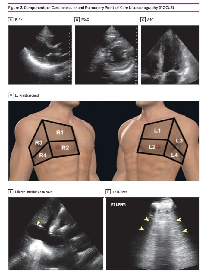 Leo_Santo5's tweet photo. 🫀🫁PoCUS Cardio - Pulmonar en el Manejo de la Disnea Indiferenciada

🔰📚JAMA 2025

doi:10.1001/jamanetworkopen.2025.30677

Enlace a Articulo Completo👇🏻✅🆓
https://t.co/xumUMHaxVK https://t.co/zqM4yhbDe0