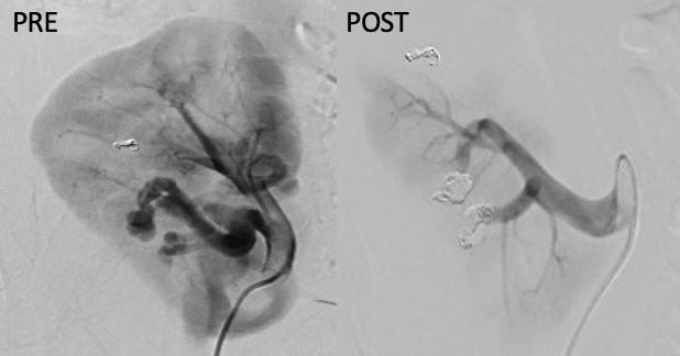 ETF_IRtrainees's tweet photo. 💡Renal arteriovenous fistula (#AVF) is a recognized complication after kidney biopsy, occurring in up to 10% of cases. 

#KidneyIR #CIRSE_ETF #RenalBiopsy #Embolization

1/3 https://t.co/lQdrTMLQJJ