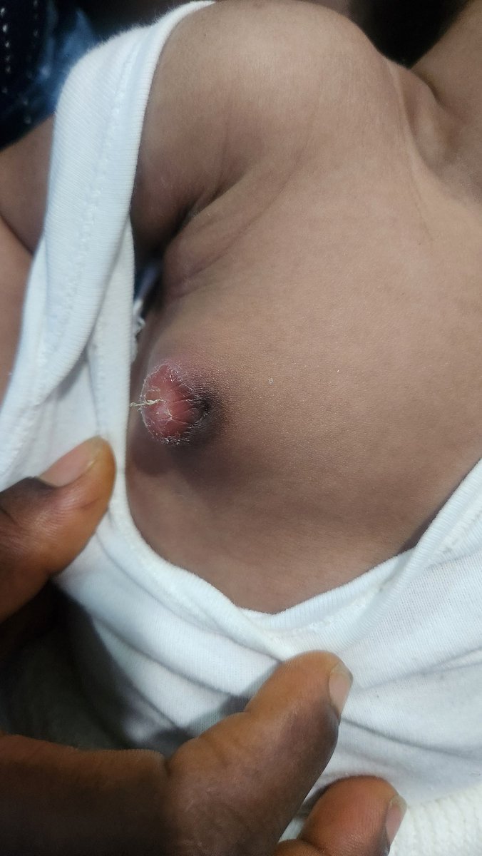 YourBabysDoctor's tweet photo. My client's mum was advised by a neighbour to squeeze out the breast milk in her baby's breast.
Unfortunately it got infected and I had to admit the newborn. 

After a while, pus gathered (picture below) and we had to drain it.
A baby's breasts may become swollen and produce milk; this is normal due to exposure to mother's hormones. It doesn't require special care. Just leave it, it will resolve over time.

Just to add: during their stay at the hospital the neighbour did not call once to check on the child, talk-less of sending money to support the parents. Be guided.