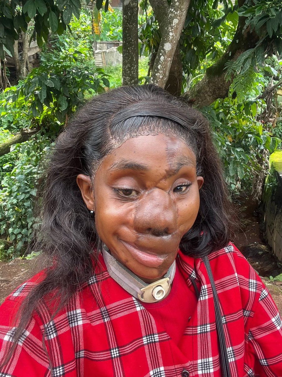 kenkenlewu's tweet photo. “Eight years ago, my life changed forever. I was shot several times in the face during the crisis in the English-speaking regions of Cameroon. The injuries were devastating, and there were moments when my future seemed uncertain. 

My face was severely damaged, my dreams were shaken, and my journey became one of unimaginable pain and countless challenges.

Yet, through the infinite mercy of God, I survived.

Every scar I carry is a testament not to my suffering, but to my survival. Every breath I take is proof that adversity does not have the final word. What was meant to destroy me became the very reason I discovered my strength.

To everyone following my journey, I want you to remember this:

Your circumstances do not define your destiny.
Your scars do not diminish your worth.
Your setbacks do not determine your future.

There will be seasons when life tests your endurance, challenges your faith, and pushes you beyond what you thought you could bear. But within every human being lies a reservoir of strength greater than any obstacle.

I stand before you today not as a victim, but as a survivor. Not as a symbol of tragedy, but as living evidence that courage can rise from pain, beauty can emerge from brokenness, and hope can flourish even in the midst of despair.

If my story teaches anything, let it be this:

Never surrender to hopelessness.
Never underestimate the power of faith.
Never allow your wounds to silence your purpose.

I am still here. I am still standing. I am still dreaming. And by God’s grace, my best chapters are yet to be written.

Thank you for walking this journey with me. Your love, prayers, and support mean more than words can ever express.

I am Median. I survived. I endured. I overcame. And I will continue to rise. ❤️🙏✨

Happy birthday to me 🎂🎂🍾🥂
©The unstoppable lady